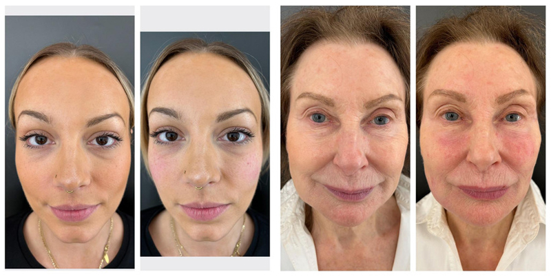 Ameela polynucleotide before and after images of two women's faces